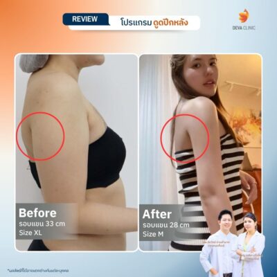 รีวิวดูดไขมันปีกหลัง 8