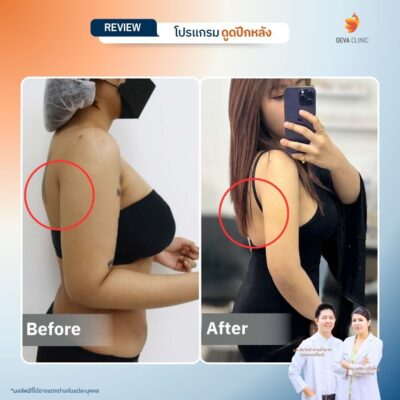 รีวิวดูดไขมันปีกหลัง 6