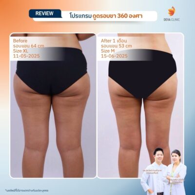 รีวิวดูดไขมันต้นขา ทางการแพทย์ 2