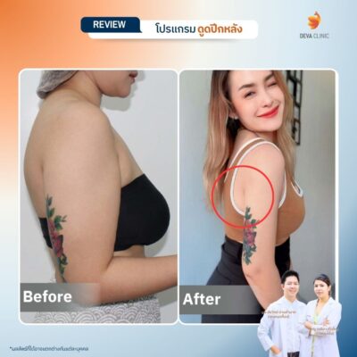 รีวิวดูดไขมันปีกหลัง 5