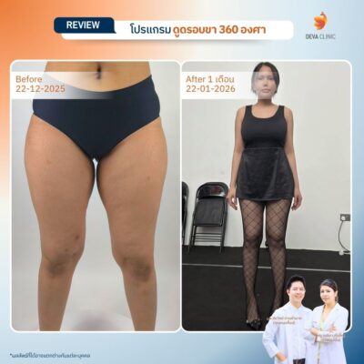 รีวิวขาใหญ่ลดยังไง ดูดไขมันต้นขา หนิง