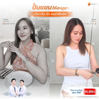 รีวิวก่อนหลังดูดไขมันแขน 360 องศา แผลเล็ก 5