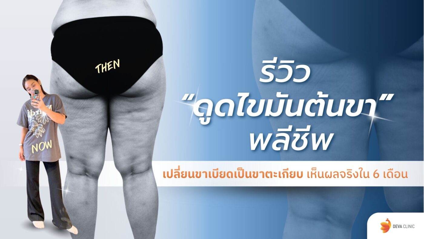 รีวิวดูดไขมันต้นขา