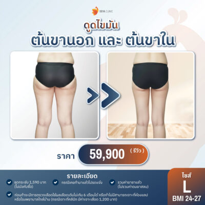 ราคาดูดไขมันต้นขา L