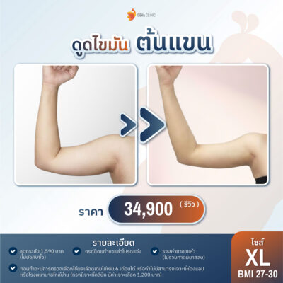 ราคาดูดไขมันต้นแขน XL