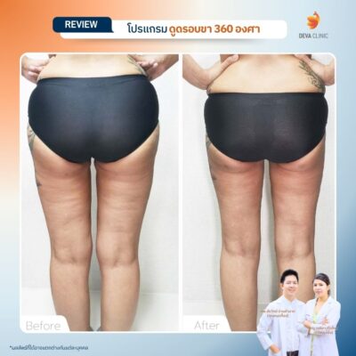 รีวิวลดเซลลูไลท์ต้นขา-ดูดไขมันต้นขา-devaclinic 10