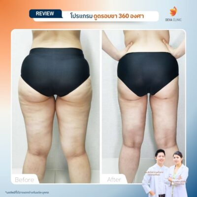 รีวิวลดเซลลูไลท์ต้นขา-ดูดไขมันต้นขา-devaclinic 2