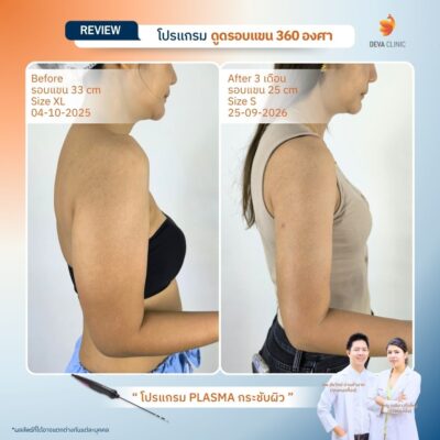 รีวิวดูดไขมันต้นแขน 8