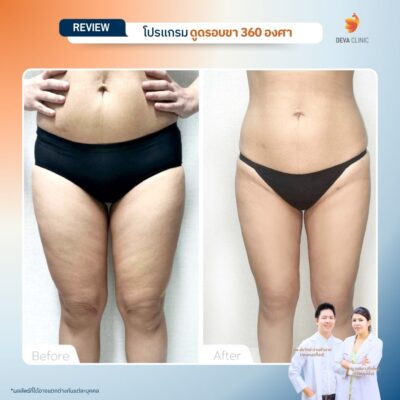 รีวิวลดเซลลูไลท์ต้นขา-ดูดไขมันต้นขา-devaclinic 12