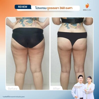รีวิวลดเซลลูไลท์ต้นขา-ดูดไขมันต้นขา-devaclinic 13