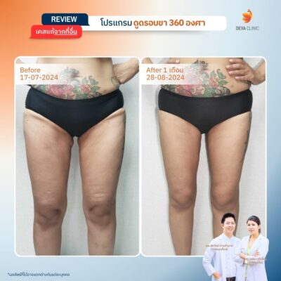 เคสที่ 3: คุณปาล์ม – ดูดใน+นอก แต่ลืมหน้า+หลัง ผลคือ “ผิวไม่เรียบ” 1