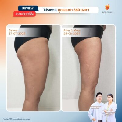 เคสที่ 3: คุณปาล์ม – ดูดใน+นอก แต่ลืมหน้า+หลัง ผลคือ “ผิวไม่เรียบ” 3