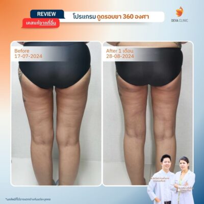 เคสที่ 3: คุณปาล์ม – ดูดใน+นอก แต่ลืมหน้า+หลัง ผลคือ “ผิวไม่เรียบ” 2