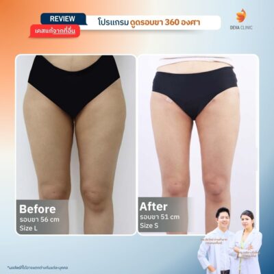 เคสที่ 2: คุณนุ่น – ดูดไม่เกลี้ยง แถมทิ้ง “ก้อนไขมันใต้ก้น” ไว้ให้ดูต่างหน้า 1