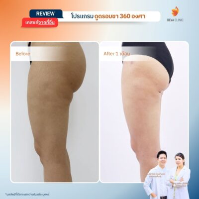 รีวิวก่อนหลัง ดูดไขมันใต้ก้น 2