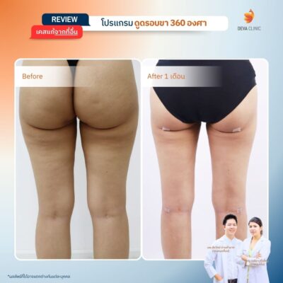 รีวิวก่อนหลัง ดูดไขมันใต้ก้น 1