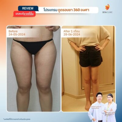 เคสที่ 1: คุณป๊อป – ดูดแค่ขาใน แต่ขากลับดู “ตะปุ่มตะป่ำ” 5