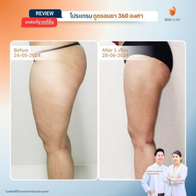 รีวิวก่อนหลัง ดูดไขมันใต้ก้น 4