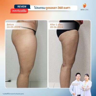 เคสที่ 1: คุณป๊อป – ดูดแค่ขาใน แต่ขากลับดู “ตะปุ่มตะป่ำ” 3