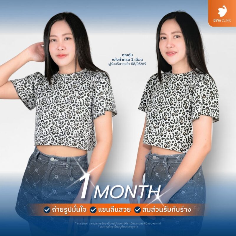 ทำไมต้องเลือกรับโปรโมชั่นดูดไขมันที่ Deva Clinic? ซ่อนแผลเนียนตา ตามร่มผ้าและรอยพับผิว