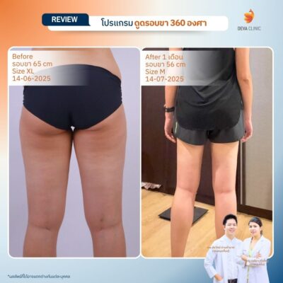 รีวิวดูดไขมันขาตะเกียบ 16