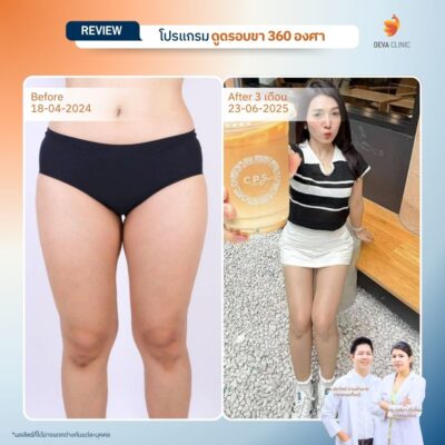 รีวิวดูดไขมันขาใหญ่กรรมพันธุ์ before after 15