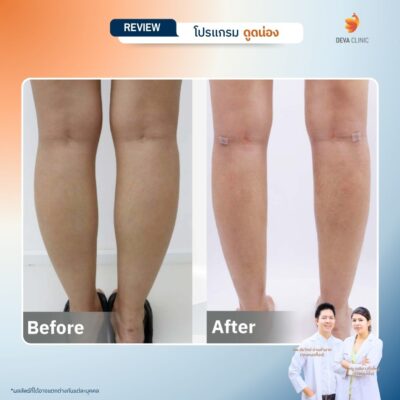 รีวิวก่อนหลังดูดไขมันน่อง 5