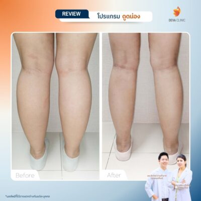 รีวิวก่อนหลังดูดไขมันน่อง 3