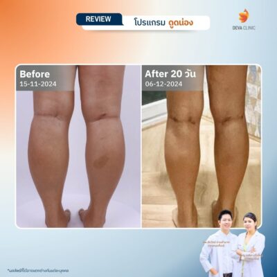 รีวิวก่อนหลังดูดไขมันน่อง 6