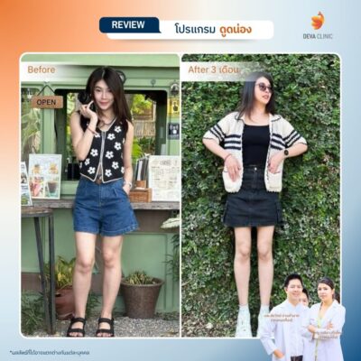 รีวิวก่อนหลังดูดไขมันน่อง 1