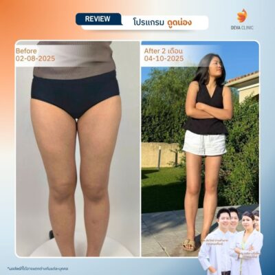 รีวิวก่อนหลังดูดไขมันน่อง 10