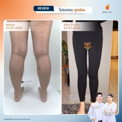 รีวิวก่อนหลังดูดไขมันน่อง 4