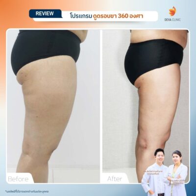 รีวิวก่อนหลัง ดูดไขมันใต้ก้น 24