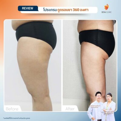 รีวิวก่อนหลัง ดูดไขมันใต้ก้น 7