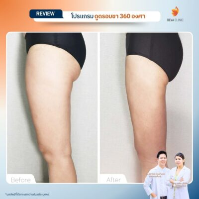 รีวิวก่อนหลัง ดูดไขมันใต้ก้น 9