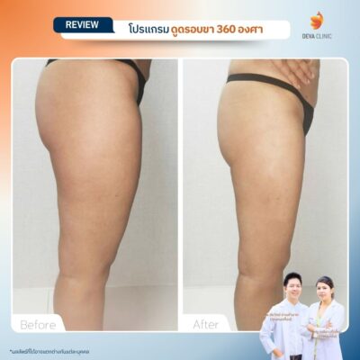 รีวิวก่อนหลัง ดูดไขมันใต้ก้น 11