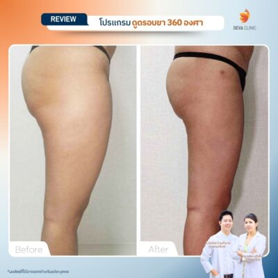 รีวิวก่อนหลัง ดูดไขมันใต้ก้น 12