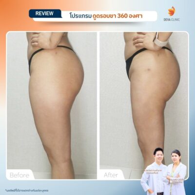รีวิวก่อนหลัง ดูดไขมันใต้ก้น 13