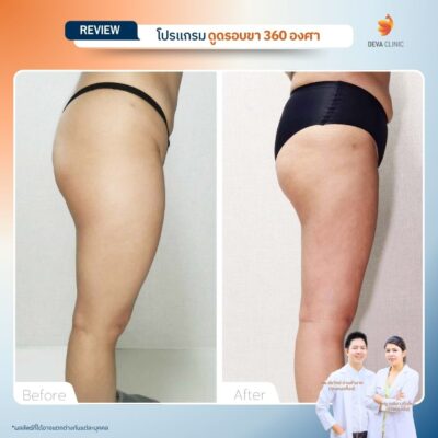 รีวิวก่อนหลัง ดูดไขมันใต้ก้น 14