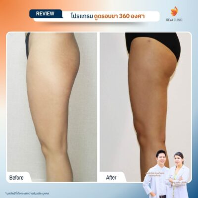 รีวิวก่อนหลัง ดูดไขมันใต้ก้น 16