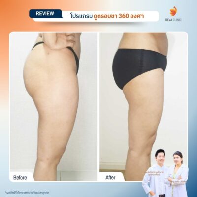 รีวิวก่อนหลัง ดูดไขมันใต้ก้น 17