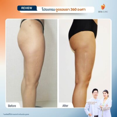 รีวิวก่อนหลัง ดูดไขมันใต้ก้น 18