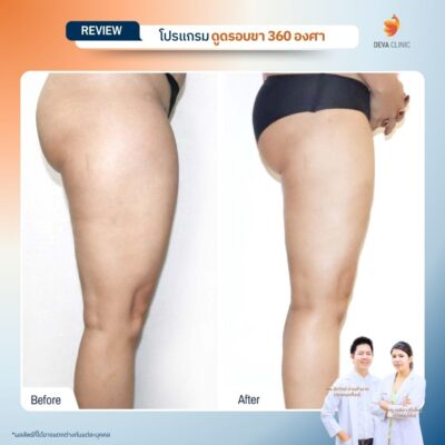 รีวิวก่อนหลัง ดูดไขมันใต้ก้น 19