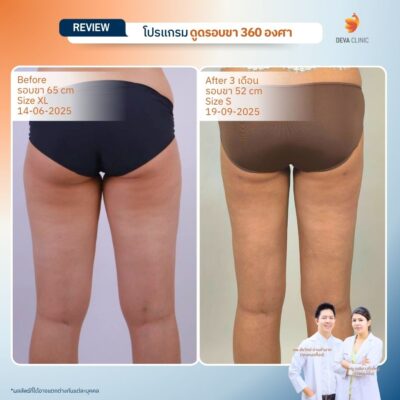 รีวิวดูดไขมันขาตะเกียบ 14