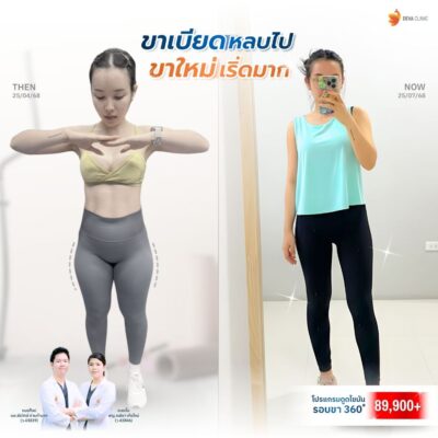 รีวิวขาใหญ่ลดยังไง ดูดไขมันต้นขา มะปราง