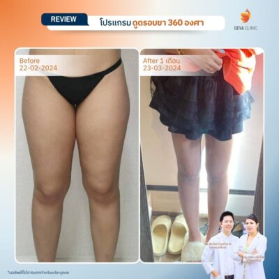 รีวิวดูดไขมันขาใหญ่กรรมพันธุ์ before after 11