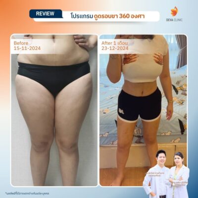 รีวิวดูดไขมันขาใหญ่กรรมพันธุ์ before after 7