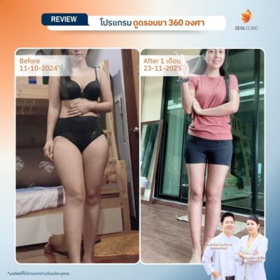 รีวิวดูดไขมันขาใหญ่กรรมพันธุ์ before after 14