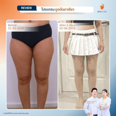 รีวิวก่อนหลัง ดูดไขมันขา 360 องศา 8
