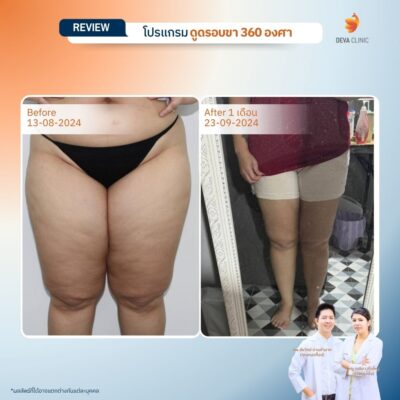 รีวิวลดเซลลูไลท์ต้นขา-ดูดไขมันต้นขา-devaclinic 5
